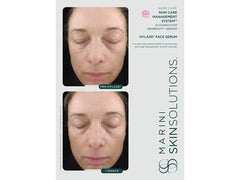 Marini SkinSolutions Hyla3D® Face Serum Hyaluronic Acid Complex