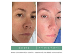 Replenix Glycolic Acid Resurfacing Peel 10%