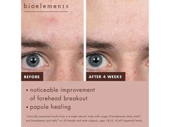 Bioelements Daily Meds Acne Clearing Serum