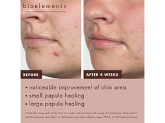 Bioelements Daily Meds Acne Clearing Serum