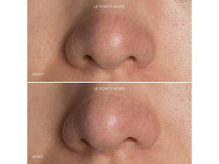 FOREO KIWI™ Blackhead Removal Device