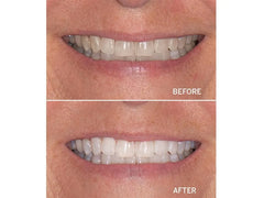 Supersmile Professional Teeth Whitening Superstrips