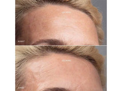 FOREO KIWI™ derma Skin Renewal Treatment