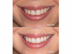 Supersmile Quikee