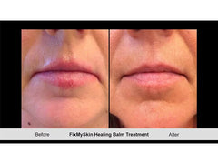 FixMySkin 1% Hydrocortisone Healing Lip Balm – Vanilla – Pack of 6