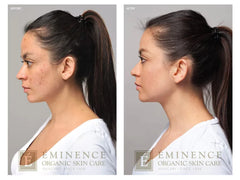 Eminence Organics Acne Advanced Treatment System