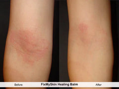 FixMySkin 1% Hydrocortisone Healing Body Balm – Fragrance-Free